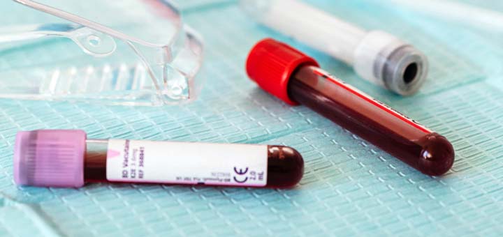 Testes de sangue deve ser usado para descubrir os níveis de hemoglobina - Photo by Karolina Grabowska from Pexels